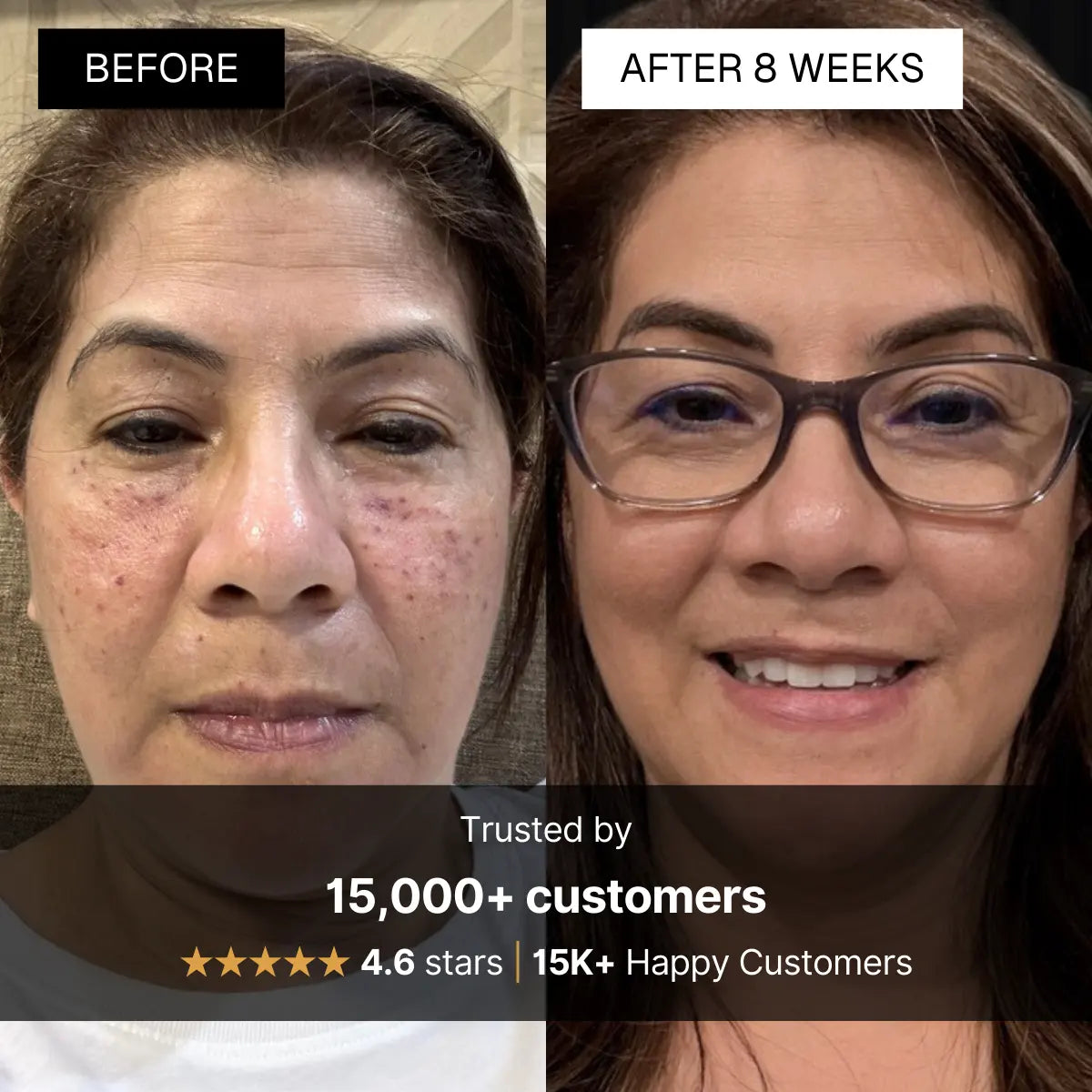 Before and after comparison of a woman's face with visible improvement after 8 weeks, featuring 15,000 happy customers badge.